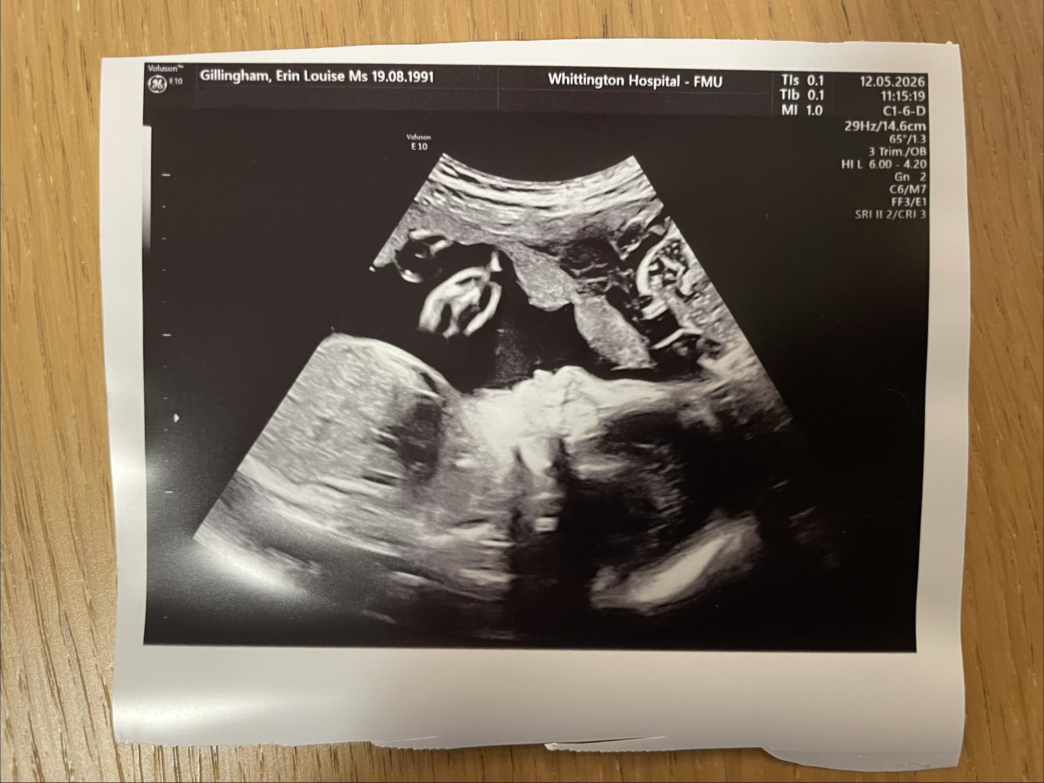 Ultrasound of baby girl